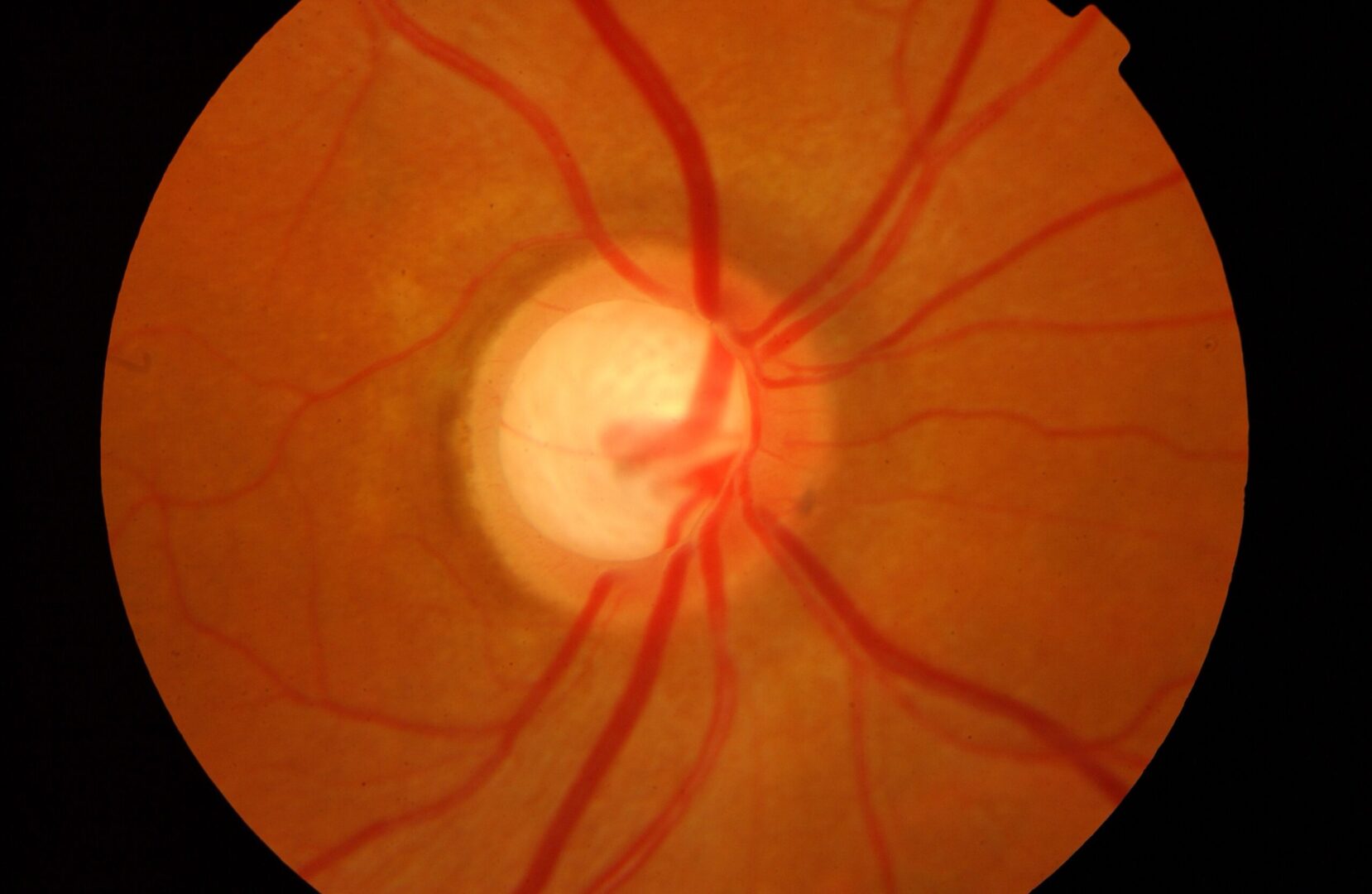 Developing Next-Generation Therapeutic Agents for Glaucoma