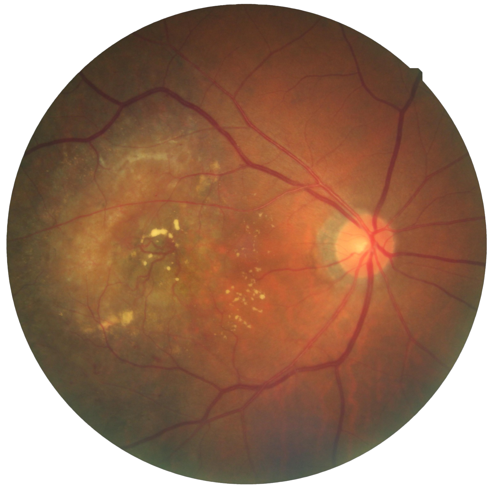 Eye Disease Diagnosis and Treatment Enabled by Novel Retinal Instrumentation